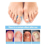 Pack 60 Parches Correctores Reparador De Uñas Encarnadas