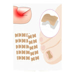 Pack 60 Parches Correctores Reparador De Uñas Encarnadas